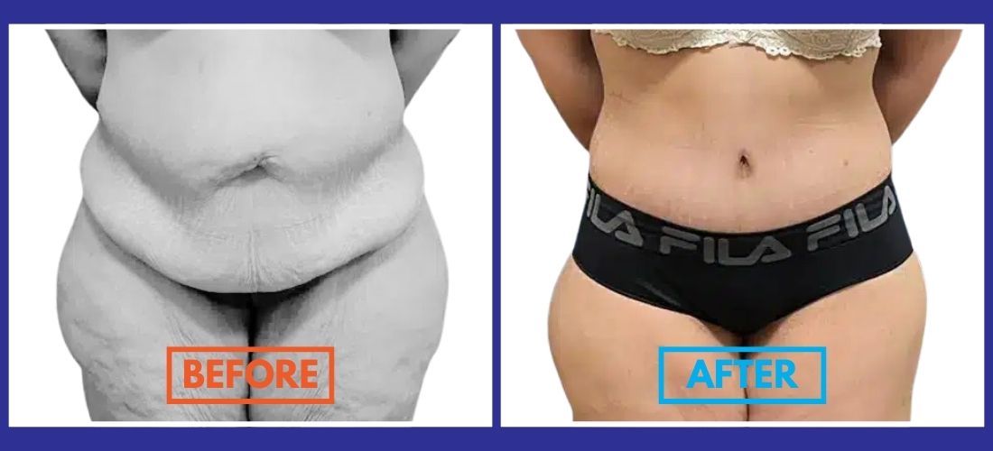 Side-by-side comparison of a woman's abdomen before and after a cosmetic procedure.