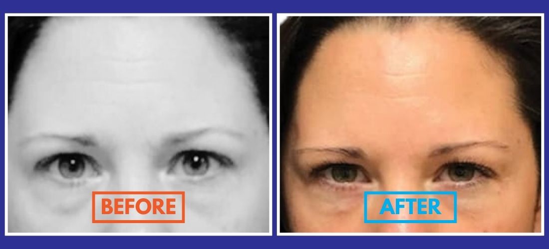 Close-up comparison of a woman's forehead and eyes before and after a treatment, highlighting reduced forehead wrinkles.