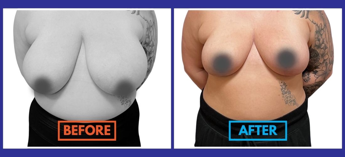 Side-by-side comparison of a person before and after breast reduction surgery, showing a reduction in breast size.