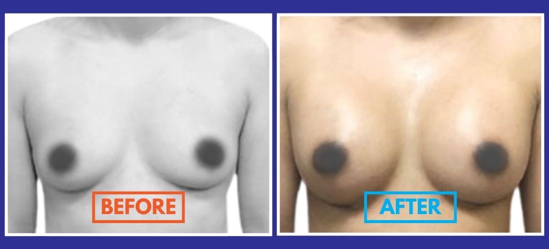 Split image showing a person's chest, labeled "Before" on the left with smaller breasts and "After" on the right with larger breasts.