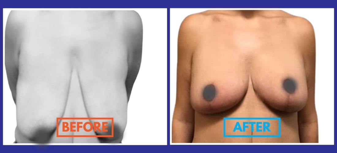 A side-by-side comparison of a person's chest before and after a breast lift procedure, highlighting significant changes in shape and volume.