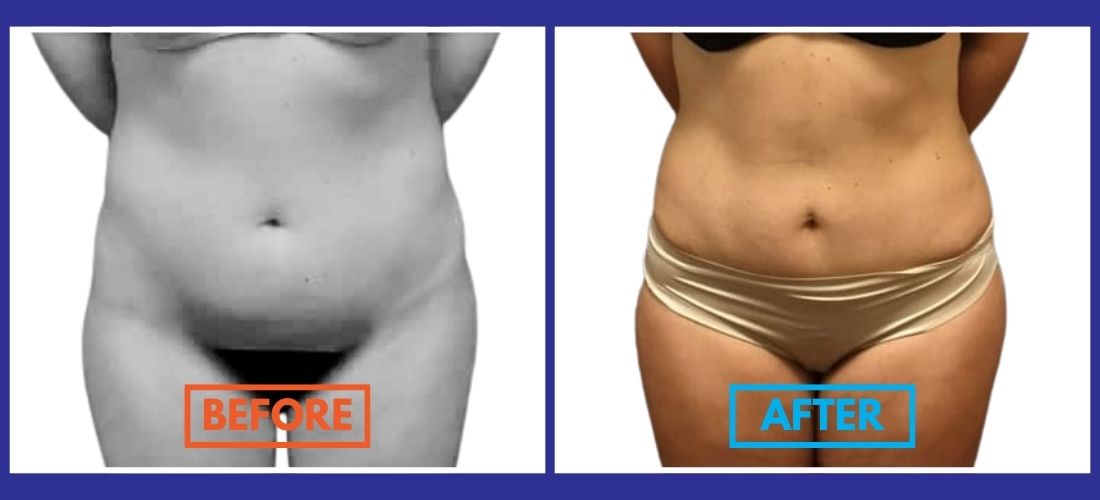 Side-by-side comparison of a person's midsection, showing "before" on the left and "after" on the right, highlighting weight or shape changes.