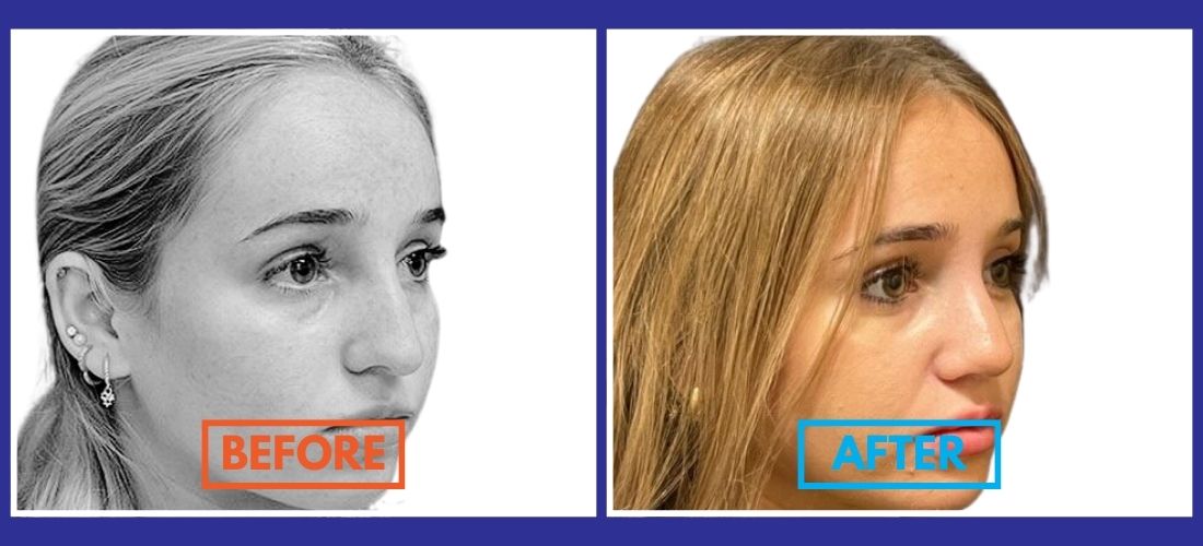 Side-by-side comparison of a woman's profile before and after a cosmetic procedure, with "Before" and "After" labels.