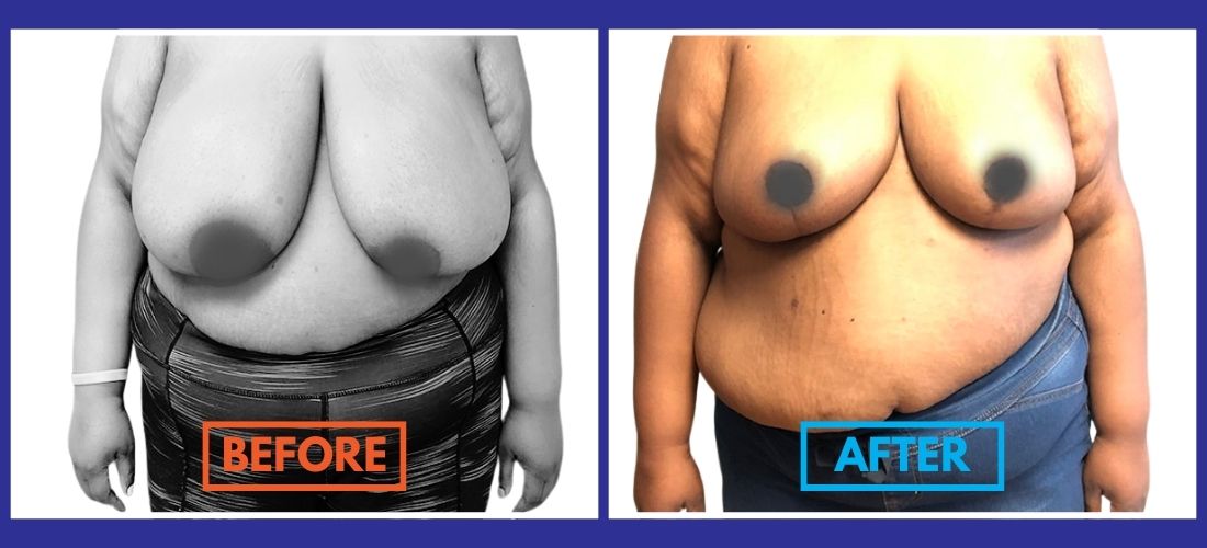 Side-by-side image showing a person before and after breast reduction surgery. The left side is labeled "Before" and the right side is labeled "After.