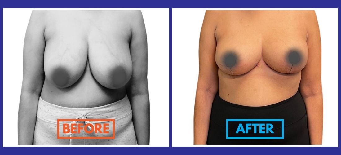 Before and after comparison of breast reduction, showing frontal view of a woman.