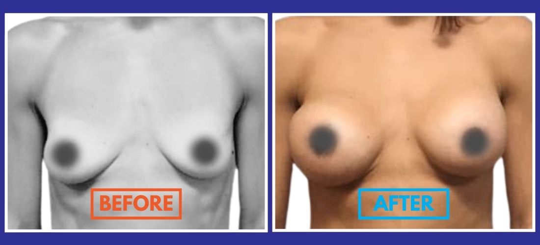 Side-by-side comparison of a woman's torso before and after breast augmentation, showing noticeable size and shape change.