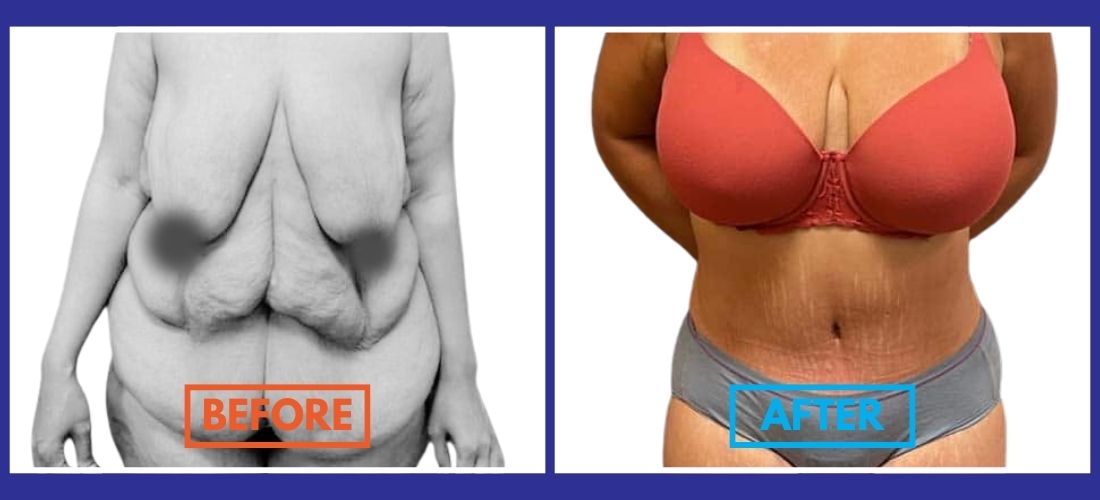 Before and after image showcasing the transformative power of cosmetic surgery: the left panel reveals a person with loose abdominal skin, while a tummy tuck in the right panel highlights their newly toned abdomen, all while wearing undergarments.