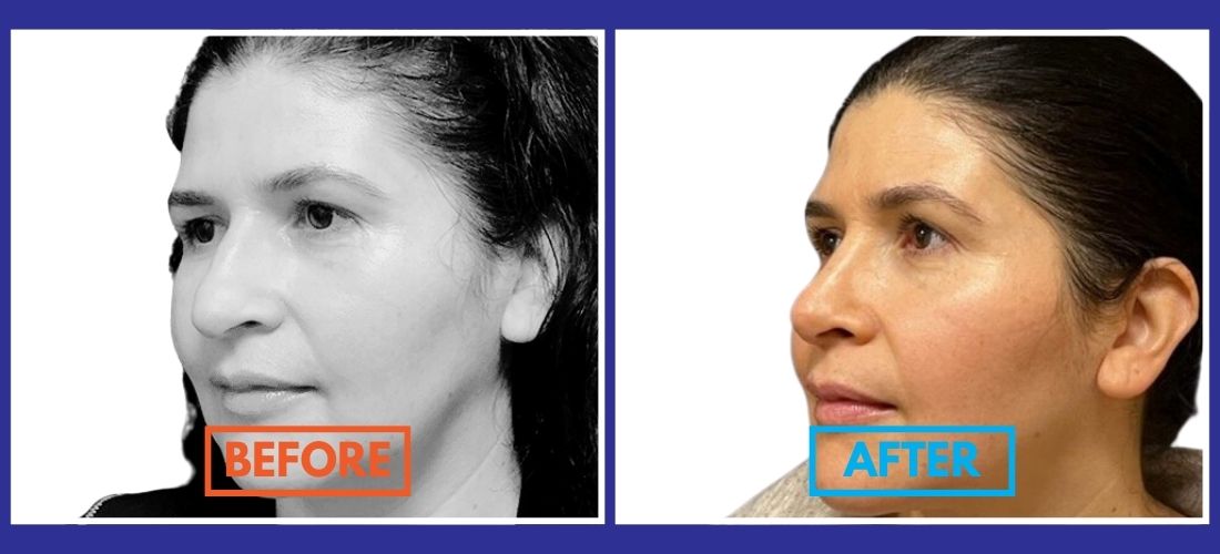 Before and after comparison of a woman's face, showcasing visible skin changes. The "before" image is in black and white, and the "after" image is in color.