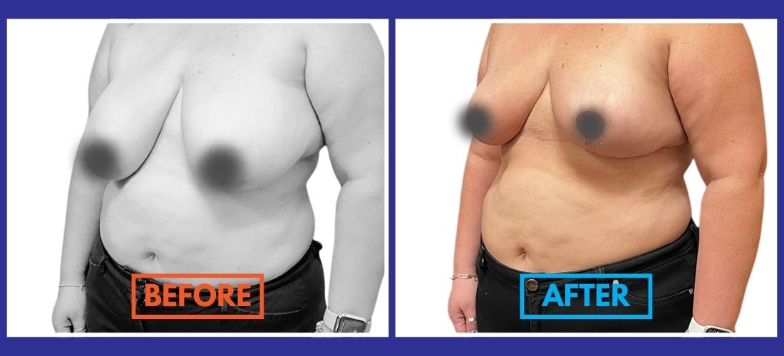 Side-by-side images showing a person's torso before and after a body transformation, highlighting changes in skin tone and body shape.