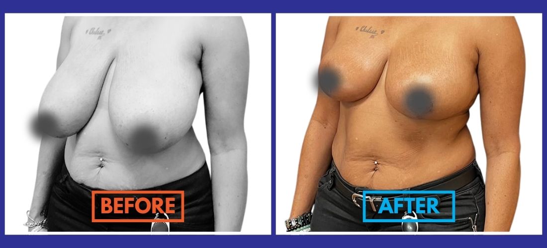 Side-by-side comparison of a person before and after a breast procedure, with the left image labeled "Before" and the right labeled "After." Both images are censored for modesty.