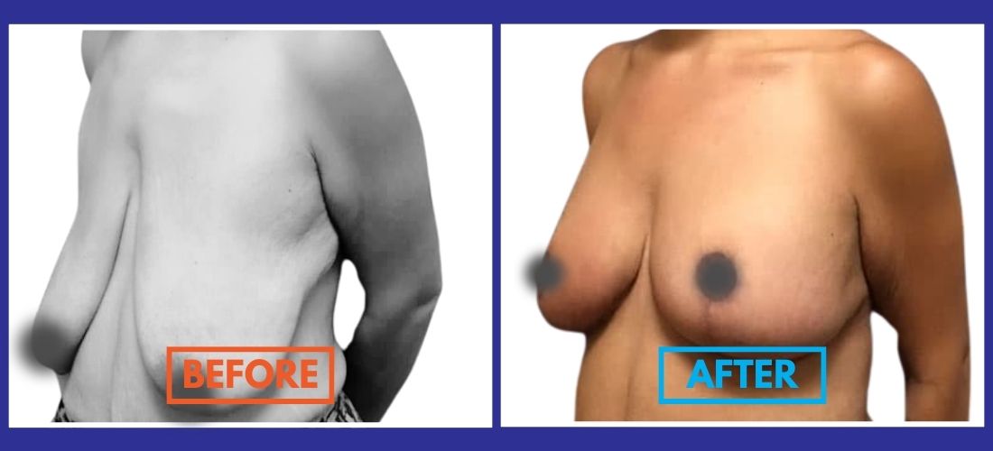 Side-by-side photos of a person's torso, labeled "Before" and "After," showing a physical transformation, possibly from a medical or cosmetic procedure.