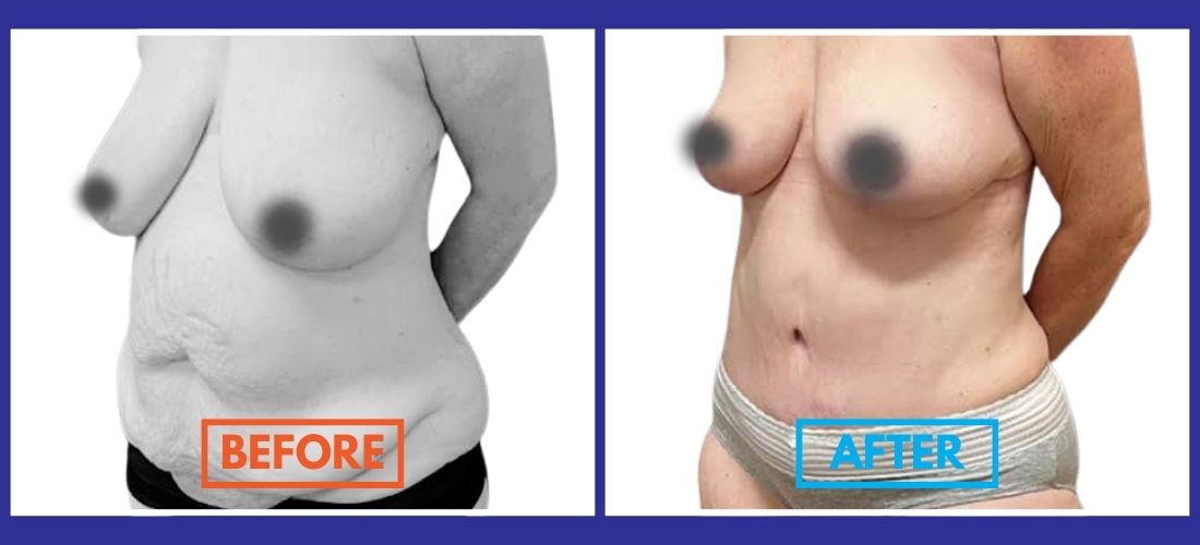 A side-by-side comparison showcases a person's torso transformation after a tummy tuck surgery, emphasizing changes in contour and appearance. "Before" is labeled in orange; "After" is labeled in blue.