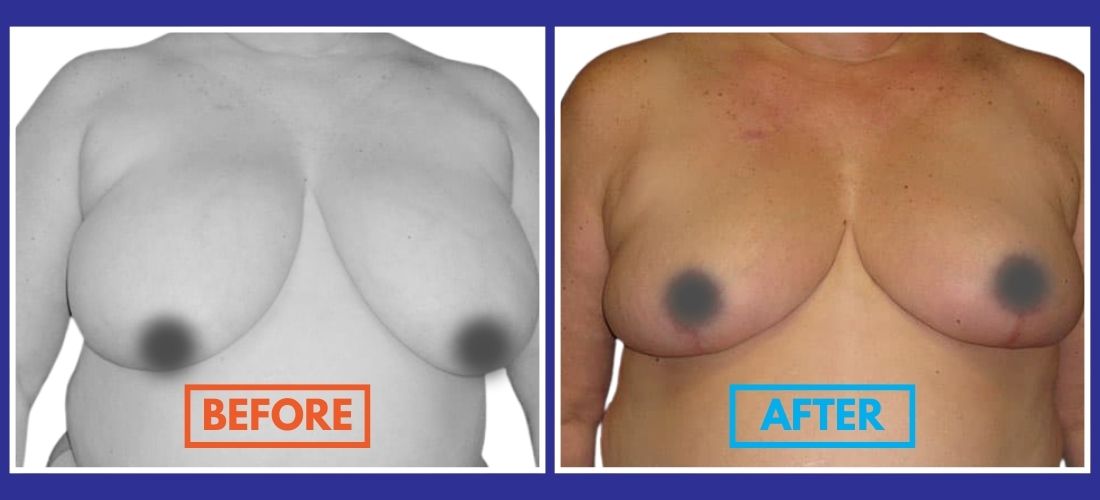 Side-by-side comparison of a person's chest showing breasts before and after a medical procedure. The left image is labeled "Before" and the right image is labeled "After.