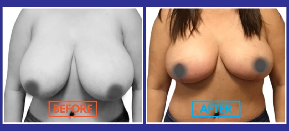 Side-by-side comparison of a person before and after breast reduction surgery, showing a reduction in size.