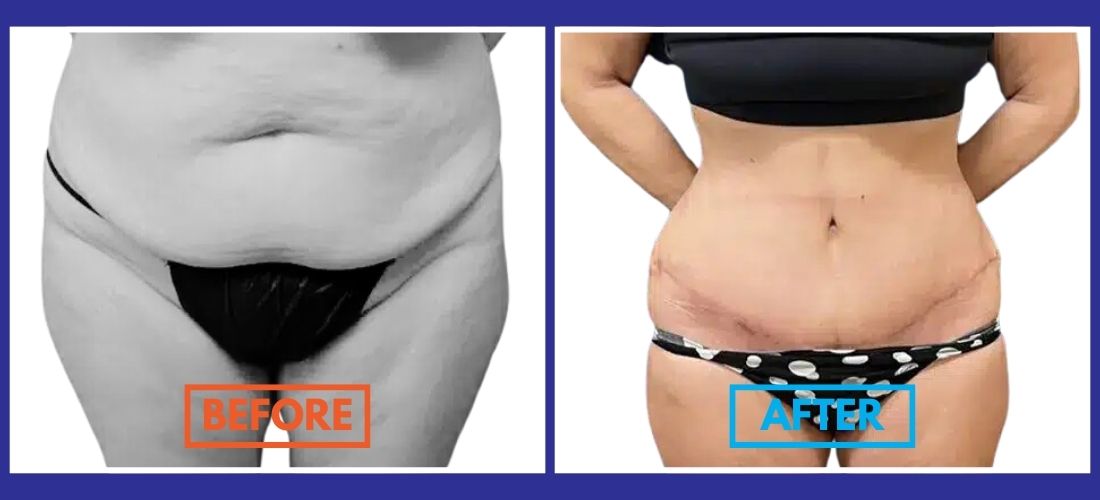 Side-by-side comparison of a woman's torso before and after a tummy tuck, revealing reduced abdominal volume and a contoured waist in the 'after' image.