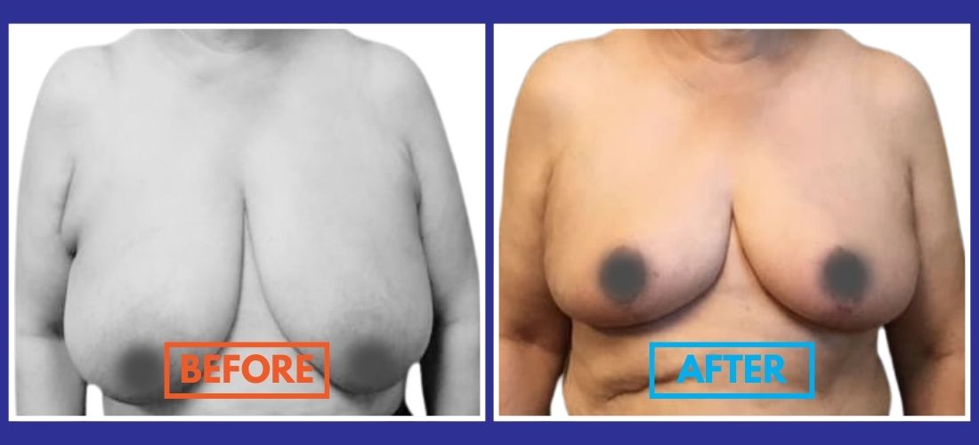 Before and after comparison of a person's torso, showing a visible reduction and lift in breast size. The left image is labeled "Before" and the right image "After.