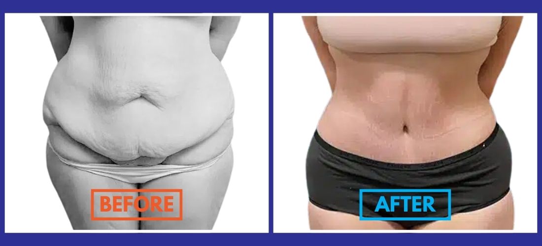 Before and after photos reveal a transformative journey in the abdominal area. The left shows loose skin, while the right highlights impressive tummy tuck results with a firmer appearance.