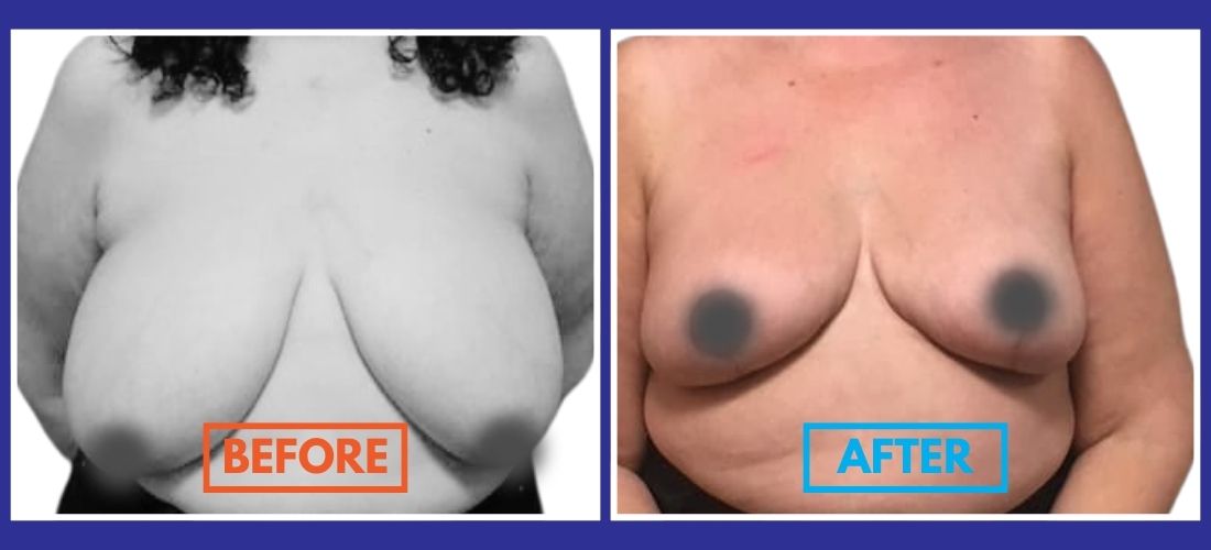 Side-by-side comparison image of a person's chest: left shows "Before" with larger size, right shows "After" with reduced size, both labeled in bold text.