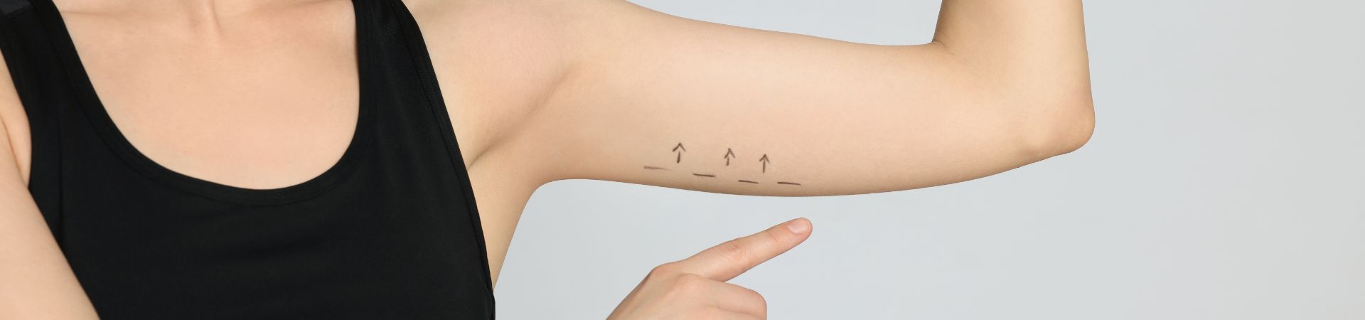 A person in a black tank top flexes their left arm, showcasing arrows and lines drawn on the skin, while pointing at it—a nod to considering an arm lift or brachioplasty on Long Island.