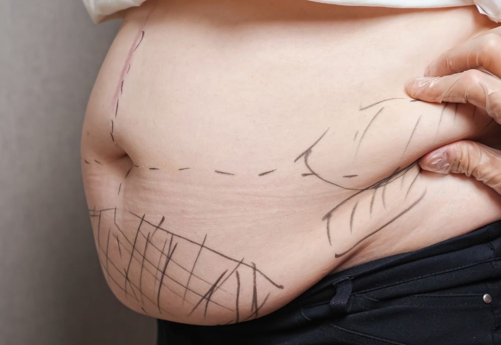 liposuction on Long island