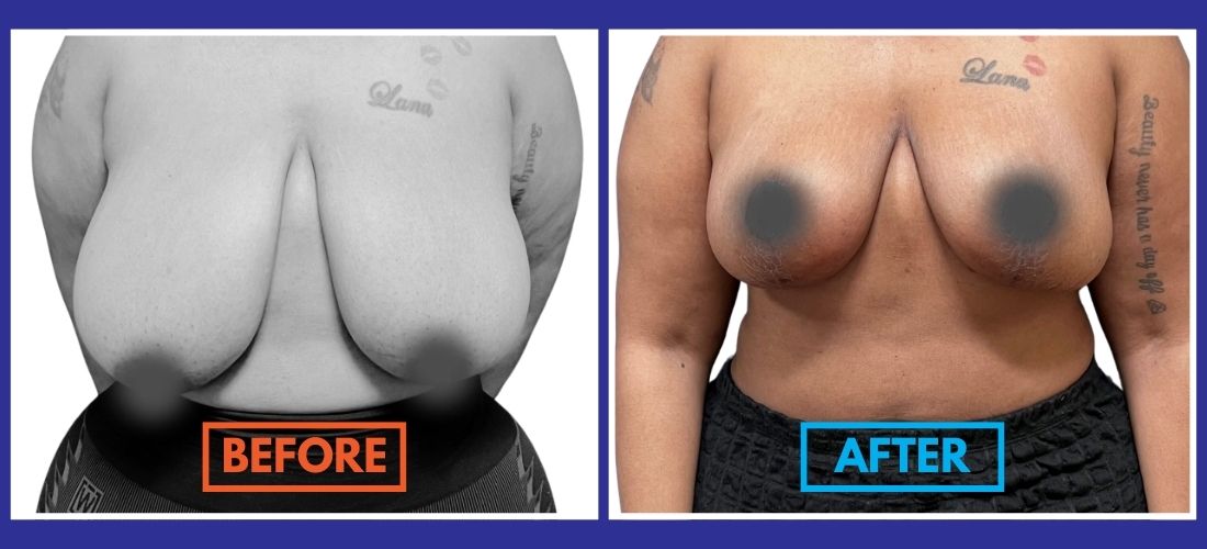 Before & Afters showcase a person's chest journey through breast surgery. The "Before" image graces the left, while the transformative "After" is captured on the right, highlighting noticeable changes post-breast reduction.