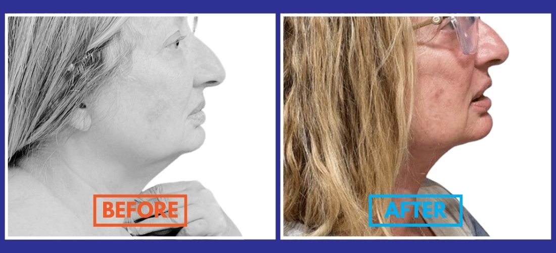 Side-by-side comparison of a person's neck and jawline before and after treatment, showing visible changes.