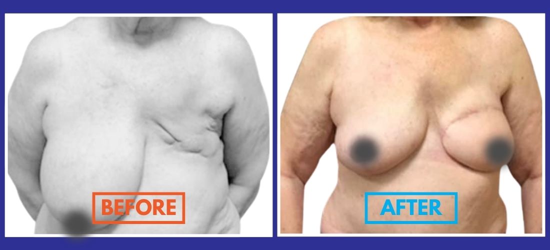 Side-by-side comparison of a person's torso with "Before" on the left showing sagging skin, and "After" on the right showing firmer skin and lifted appearance.