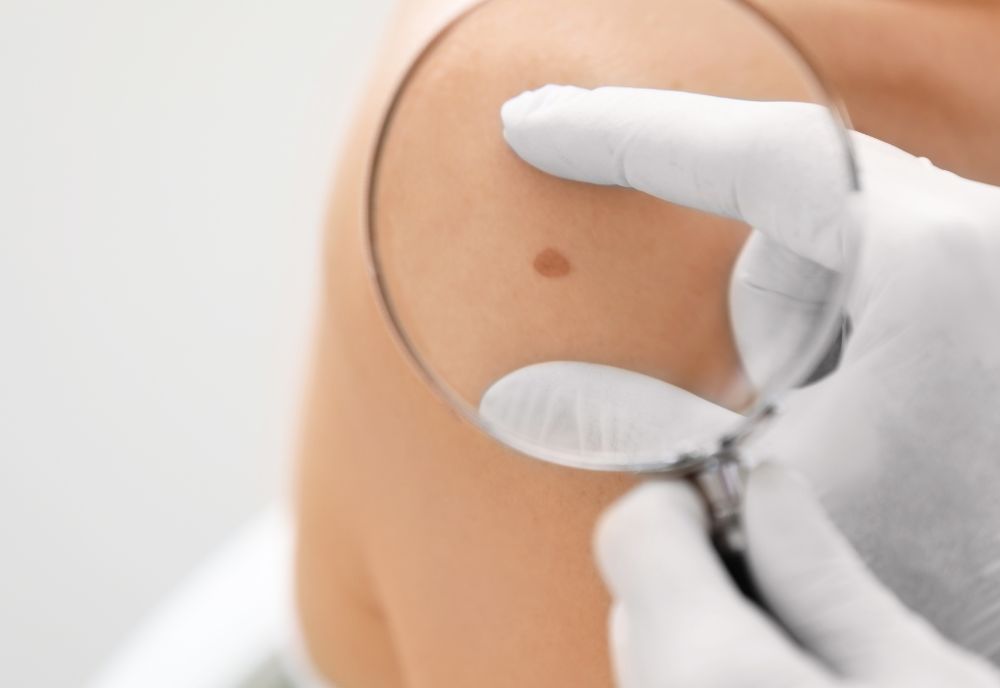 Skin Cancer Excision Reconstruction on Long Island