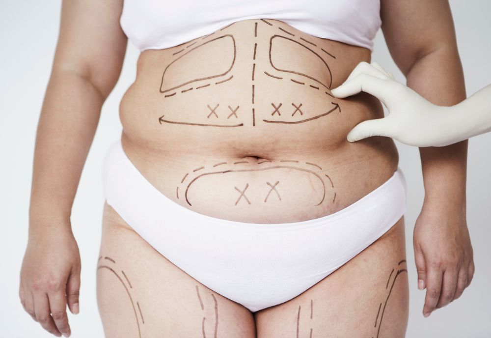 A person wearing white undergarments on Long Island displays surgical markings on their abdomen and thighs, with a gloved hand pinching the skin, showcasing cosmetic procedures.