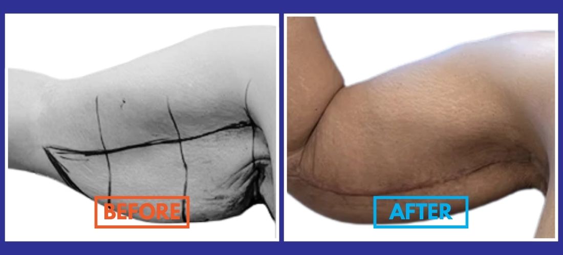 Before and after image of an arm showing changes post-surgery, highlighting tightened skin and reduced sagging.