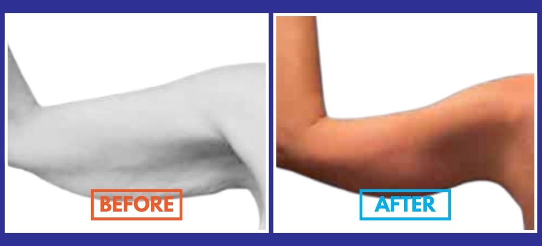 Side-by-side images showing an arm labeled "Before" with loose skin and "After" with tightened skin, framed in orange and blue, respectively.