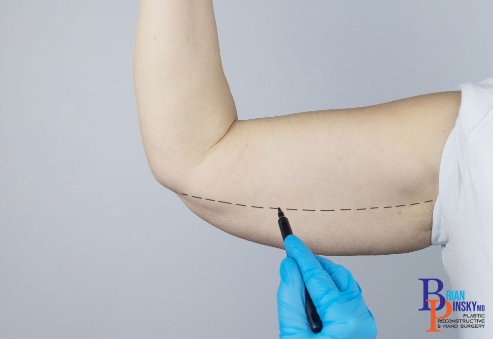 A gloved hand skillfully marks a dashed line on the underside of a person's arm with a black pen, preparing for the cosmetic procedure ahead.