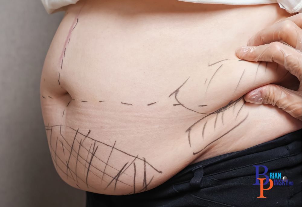 Close-up of a person's abdomen with surgical markings, indicating preparation for a cosmetic procedure.