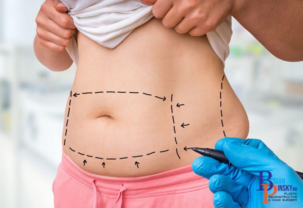 A person's midsection, marked with black dashed lines, outlines areas designated for cosmetic procedures. A blue-gloved hand holds a marker, poised to enhance natural beauty.