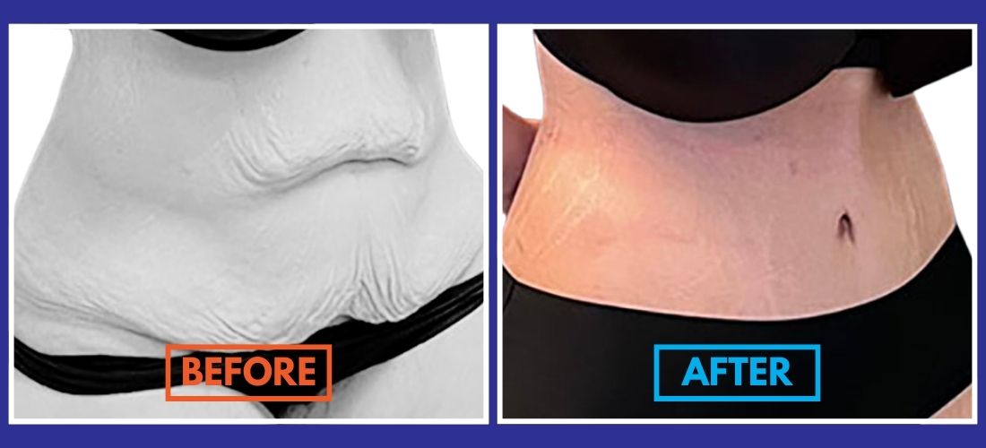 Side-by-side images showcase a person's abdomen transformation. The left, labeled "Before," displays loose skin, while the right, labeled "After," reveals a firmer look, akin to post-Tummy Tuck results. Both images feature the person in black underwear.