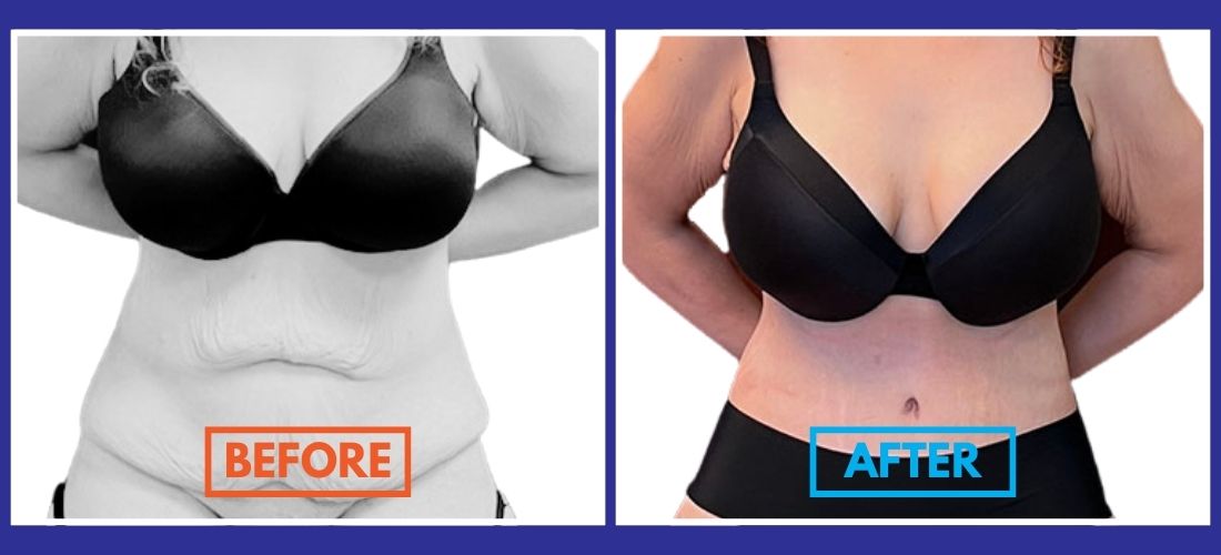 Side-by-side comparison of a woman's torso in black underwear showcases her stunning Tummy Tuck results. The "before" image displays excess skin, while the "after" image reveals a more toned transformation.