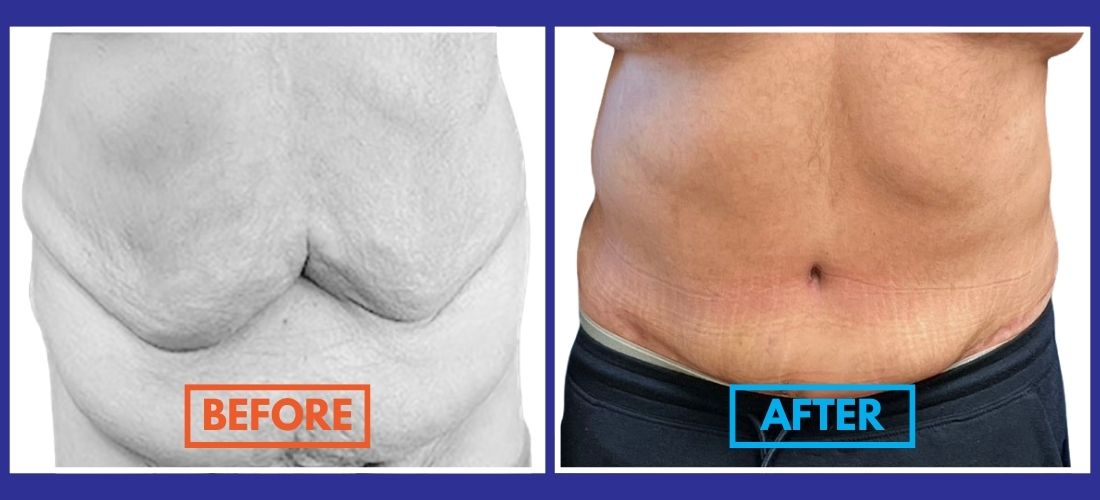 Side-by-side comparison of a person's abdomen showcases a "before" image with loose skin and an "after" image with smoother results, possibly following a tummy tuck cosmetic surgery.