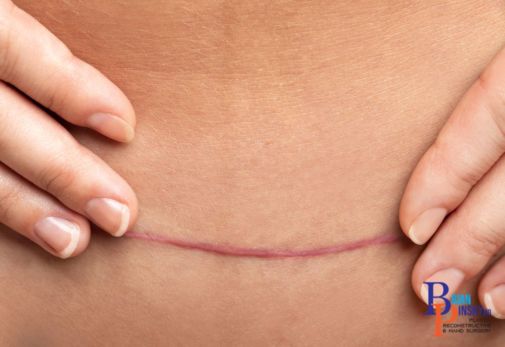 Close-up of hands gently holding skin around a horizontal scar on a person's abdomen, possibly showcasing the aftermath of cosmetic procedures.