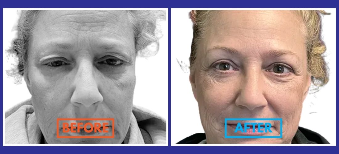 Side-by-side images of a woman's face labeled "Before" and "After," highlighting remarkable improvements in skin appearance following eyelid surgery.