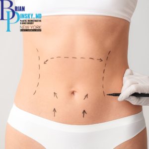 Person in white undergarments, with a gloved hand marking arrows and lines on their abdomen, suggesting plastic surgery after weight loss on Long Island.