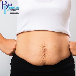 Close-up of a person's abdomen showing loose, stretched skin with some wrinkling and a visible linea nigra, partially covered by a white shirt—an image often seen after weight loss or before plastic surgery in Suffolk County.