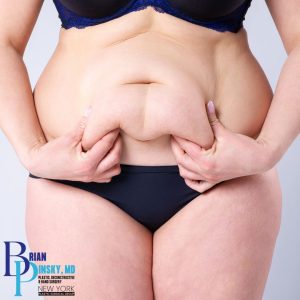 A person wearing black underwear and a dark bra pinches excess skin and fat on their abdomen, highlighting changes often seen after weight loss. The logo "Brian Pinsky, MD" appears in the bottom left corner.