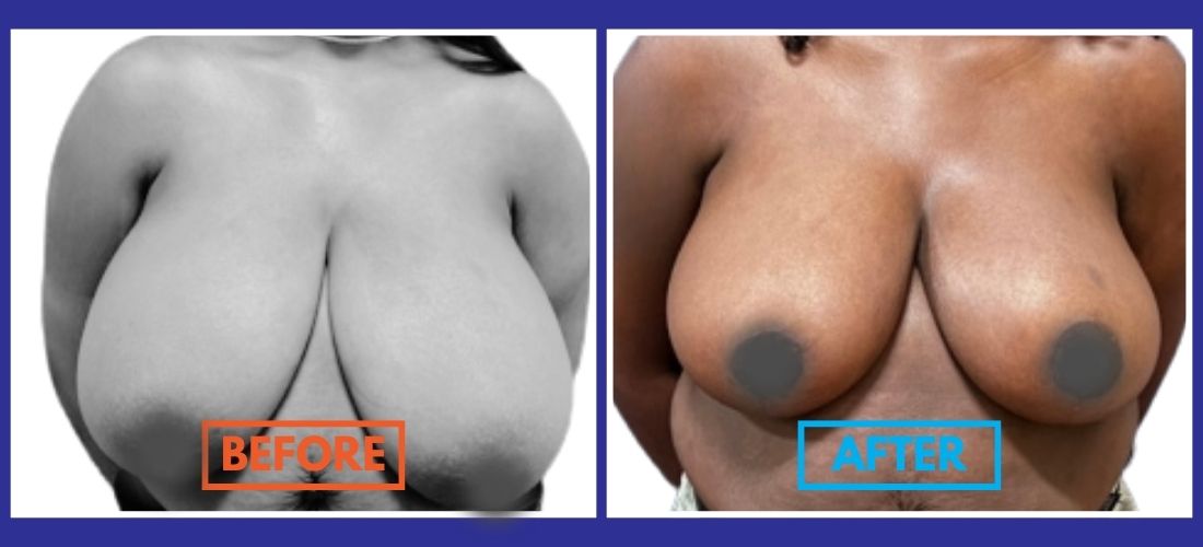 Side-by-side comparison of a woman’s chest before and after breast reduction surgery, with "before" and "after" labels on each image.