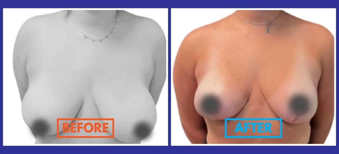 Side-by-side comparison photo showing a person's chest before and after breast surgery, with "before" and "after" labels.