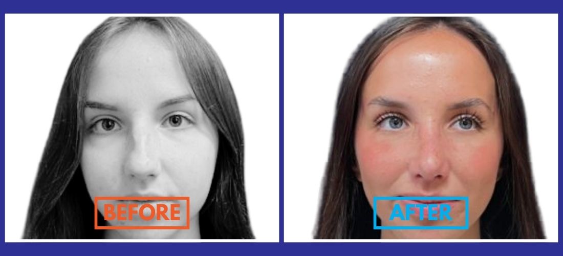 Side-by-side photos of a woman’s face, labeled "Before" and "After," showing differences in skin tone, lip color, and eye appearance.