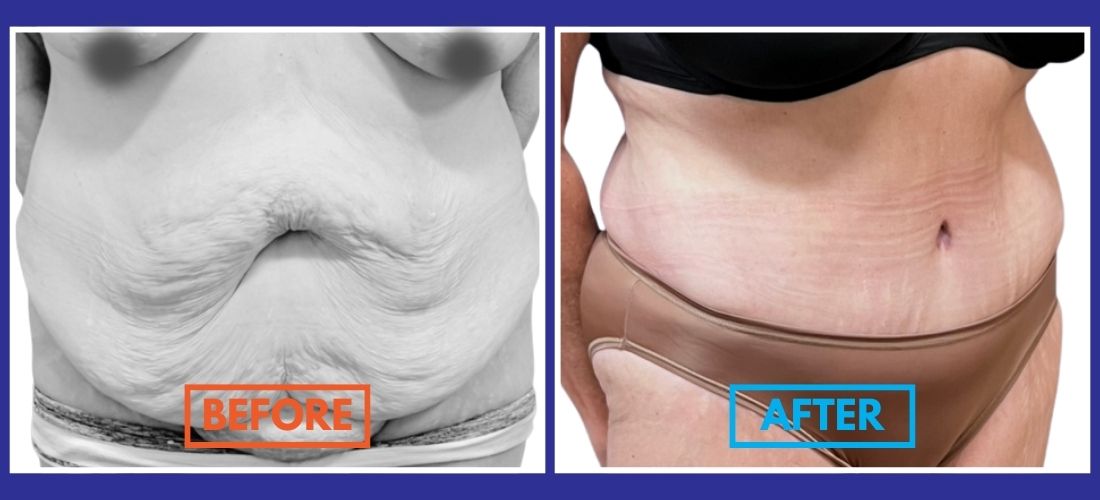 Side-by-side comparison showing a woman's abdomen before and after a procedure, with visible reduction in loose skin and smoother appearance in the "after" image.